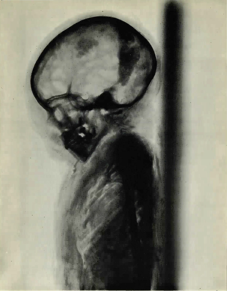 X-ray of a young girl's head and torso, profile view