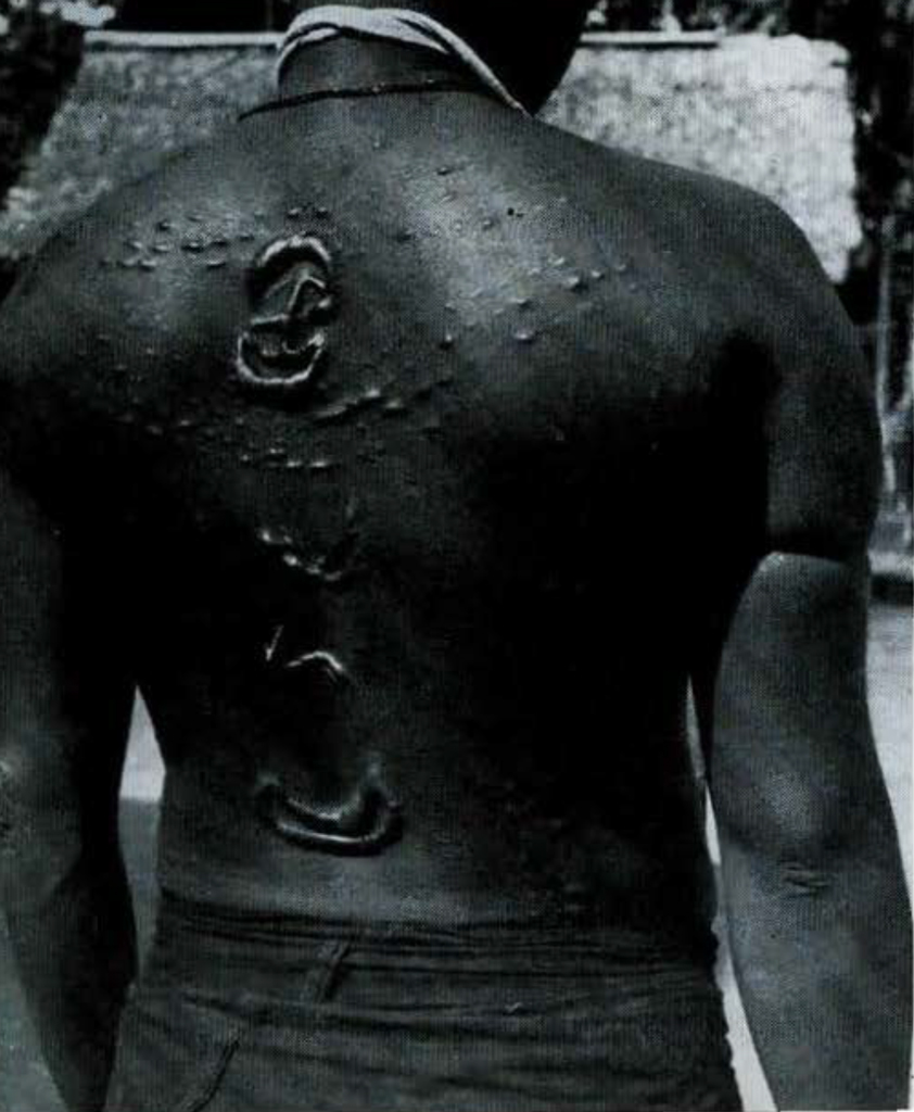 The back of a woman with a pattern of raised scars.