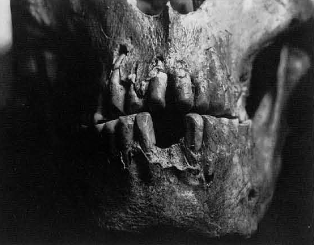 Close up of front teeth of a neanderthal showing wear that rounded the teeth.