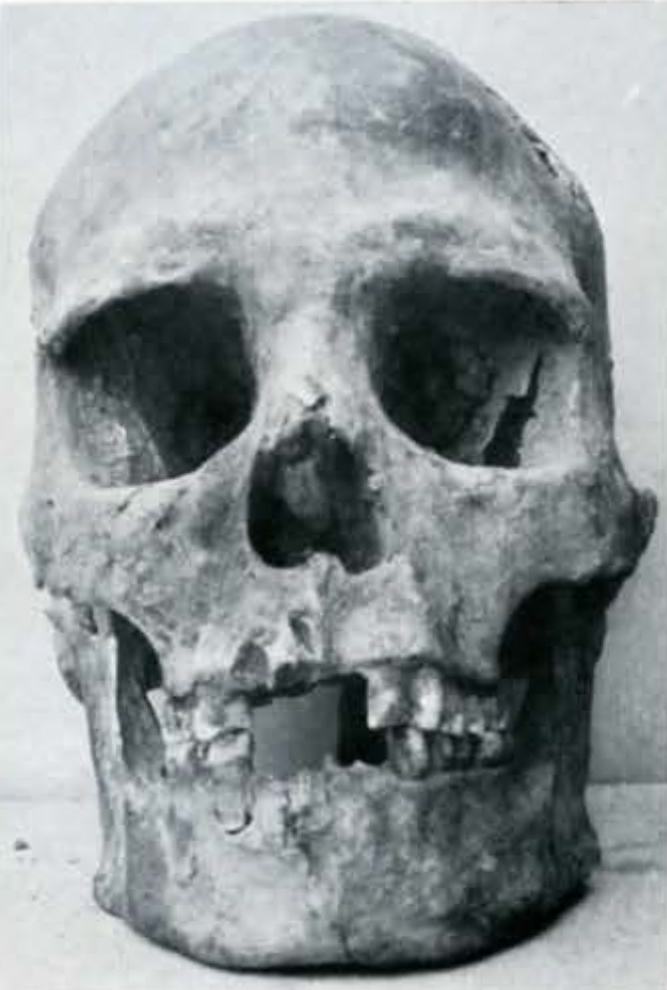 A human skull with front teeth missing